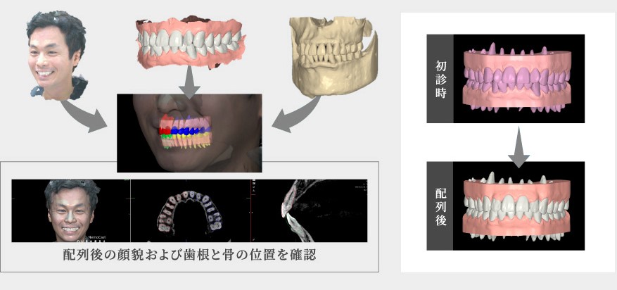 配列後の顔貌および歯根と骨の位置を確認